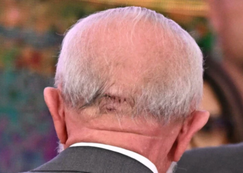 Lula tem complicação “comum” em idosos e não terá sequela, dizem médicos