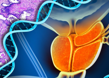 Não é verdade que o câncer de próstata acomete somente homens idosos