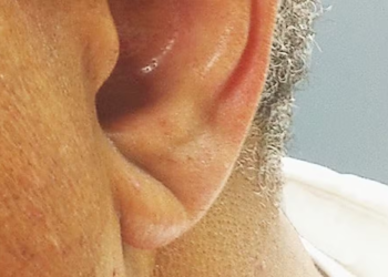 Sinal de Frank na orelha X risco de infarto: quando surgiu essa ligação?