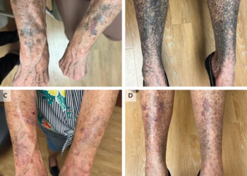 Idosa dos EUA fica com pele azulada e preta após reação rara a antibiótico para rosácea; estudo analisou caso