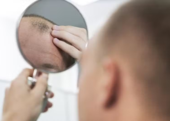 Calvície: novo medicamento contra queda de cabelo é apontado como o maior avanço em décadas